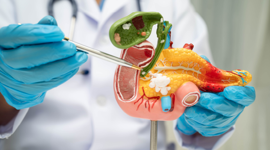 Gençlerde safra kesesi kanseri artışı